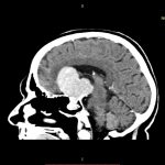 Neuromed 11 245